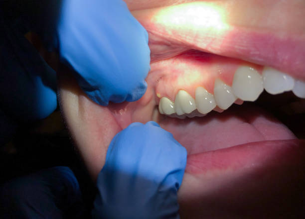 Best Emergency Dentist for Lost Fillings or Crowns in Star Valley Ranch, WY